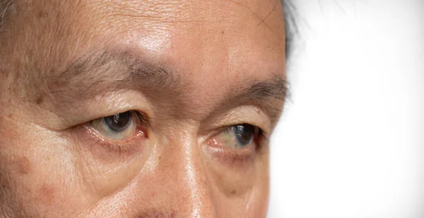 Skin creases around the eye of Asian elder man showing aging.