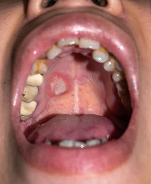 Aphthous Ulcer Stress Ulcer Mouth Asian Male Patient — Stock Photo, Image