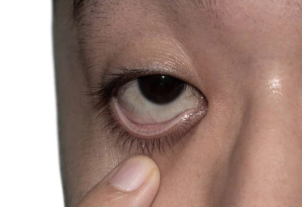 Pale Skin Asian Young Man Sign Anemia Pallor Eyelid — Stock Photo, Image