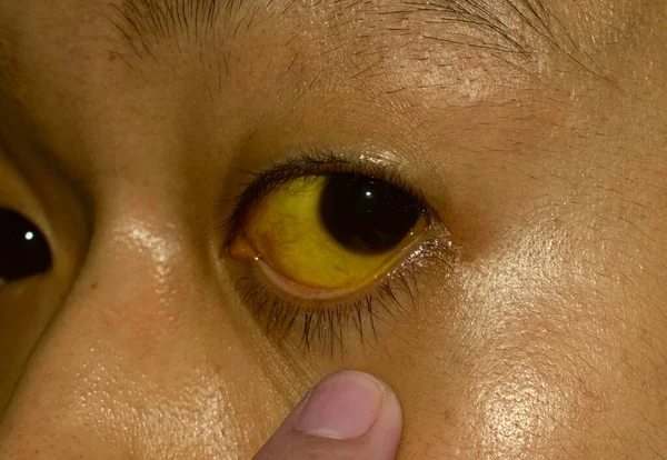 Deep Jaundice Asian Male Patient Yellowish Discoloration Skin Sclera Hyperbilirubinemia — Stockfoto