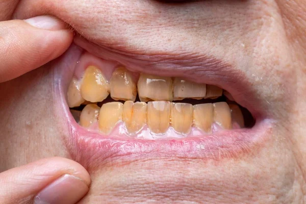 Crowded teeth with yellow colored tobacco stains. Poor oral hygiene.
