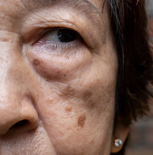 Kleine Braune Flecken Altersflecken Genannt Gesicht Einer Älteren Frau Aus — Stockfoto