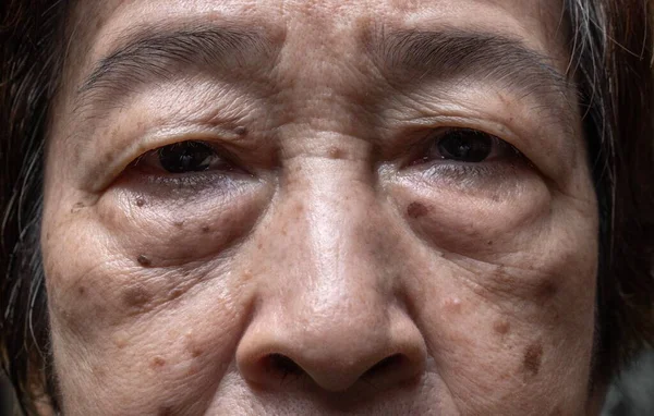 Маленькие Коричневые Пятна Называются Возрастными Пятнами Лице Азиатской Пожилой Женщины — стоковое фото