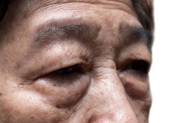 Prominent fat bag under eye of Asian elder woman. Closeup view.