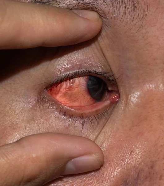 Corneal Infection Ulcer Called Keratitis Asian Old Man — 스톡 사진