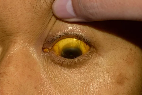 Hluboká Žloutenka Asijského Pacienta Žluté Zabarvení Kůže Skléry Hyperbilirubinémie Akutní — Stock fotografie