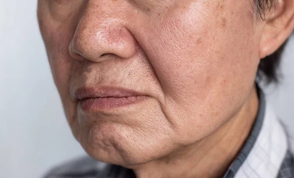 Enlarged pores in face of Southeast Asian, Chinese elder man with skin folds.