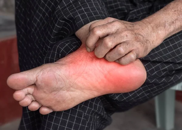 Asyalı Yaşlı Bir Adamın Kaşındıran Ayak Derisi Uyuz Mantar Enfeksiyonu — Stok fotoğraf