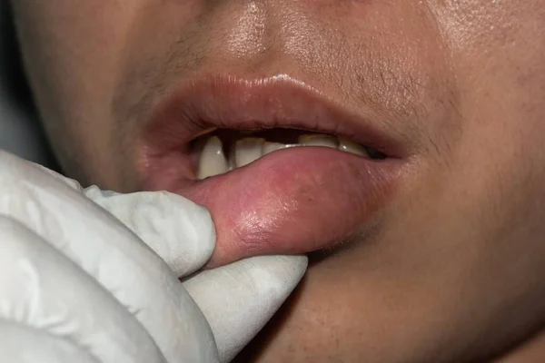 Asyalı Genç Adamın Şişmiş Kalınlaşmış Dudağı Anjiyoödem Sebebi Alerji Enfeksiyon — Stok fotoğraf