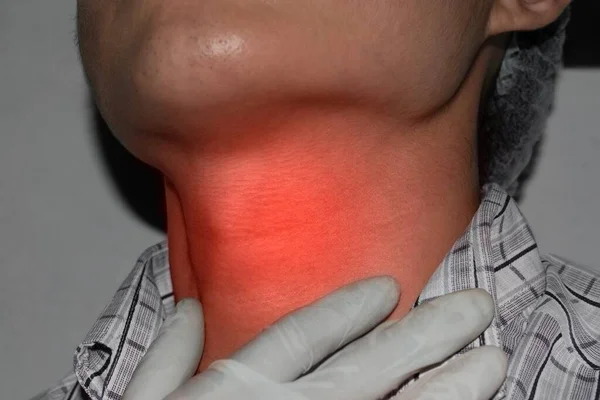 亚洲人脖子上的红晕 缅甸年轻人 甲状腺炎 甲状腺功能亢进或吞咽困难的概念 — 图库照片