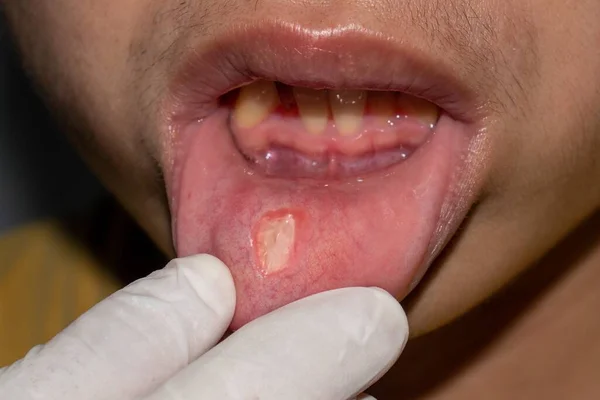 Aphthous Ulcer Stress Ulcer Mouth Asian Male Patient — Stok fotoğraf