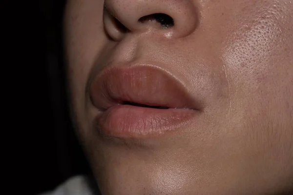 亚洲年轻人的上唇丰满或厚实 血管水肿 原因可能是过敏 受伤等 — 图库照片