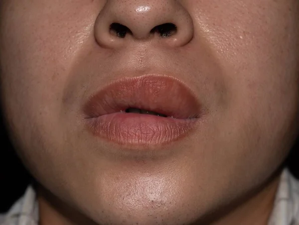 Swollen Thickened Upper Lip Asian Young Man Angioedema Causes May — Stock Photo, Image