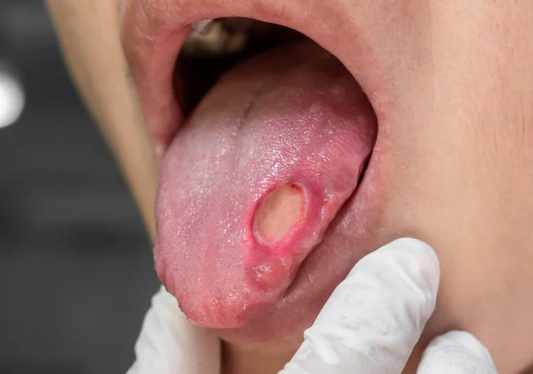 Ulcer Tongue Asian Male Patient Diagnosis May Aphthous Ulcer Canker — Stock Photo, Image