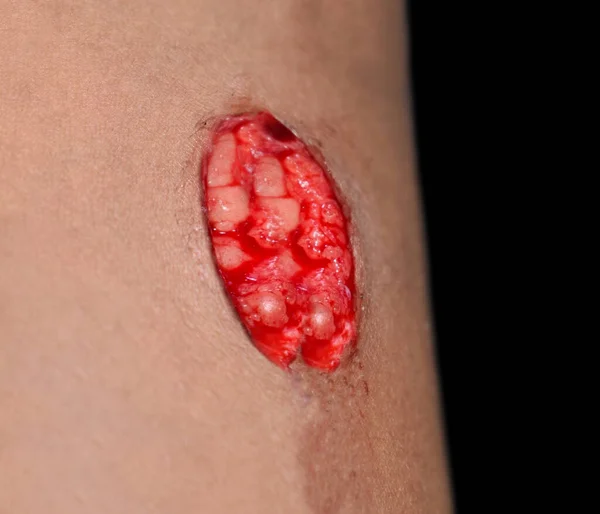 Herida Lacerada Con Leve Sangrado Lesión Traumática Muslo Niño Asiático — Foto de Stock