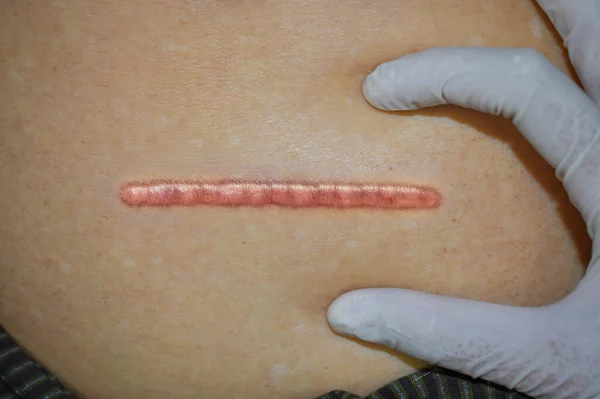 Cicatrice Cheloide Pulita Ordinata Pulita Incisione Chirurgica Dritta Vista Dall — Foto Stock