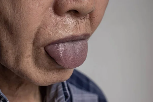 Cianose Central Sudeste Asiático Homem Velho Com Doença Cardíaca Congênita — Fotografia de Stock