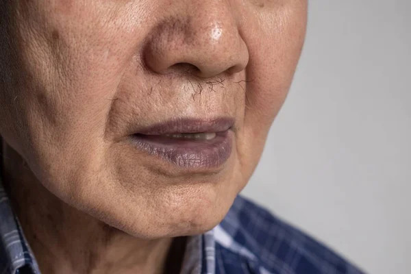 Sianosis Pusat Asia Tenggara Orang Tua Dengan Penyakit Jantung Bawaan — Stok Foto