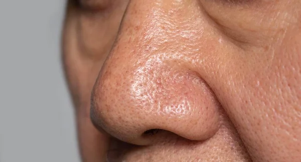 Melebar Pori Pori Hidung Orang Tua Asia — Stok Foto