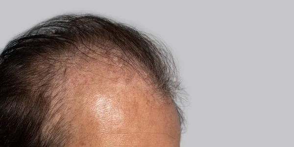 Plešatá Hlava Asijského Staršího Muže Koncept Mužského Vzoru Vypadávání Vlasů — Stock fotografie