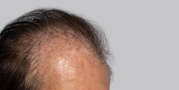 Bald head of Asian elder man. Concept of male pattern hair loss or sparse hair.