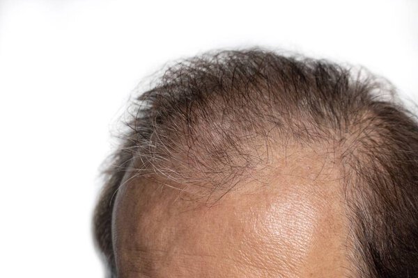 Лысая голова азиатского старейшины. Концепция мужского образца выпадения волос или редкие волосы.