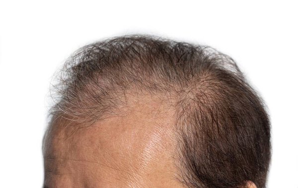 Bald head of Asian elder man. Concept of male pattern hair loss or sparse hair.