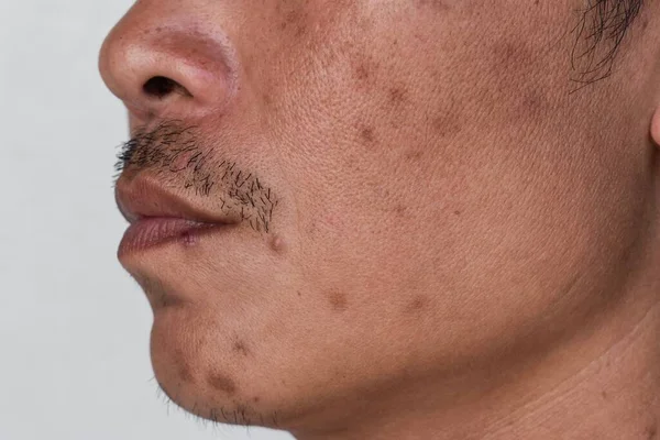 Small brown patches called age spots and scars on the face of Asian man. Liver spots, senile lentigo, or sun spots.