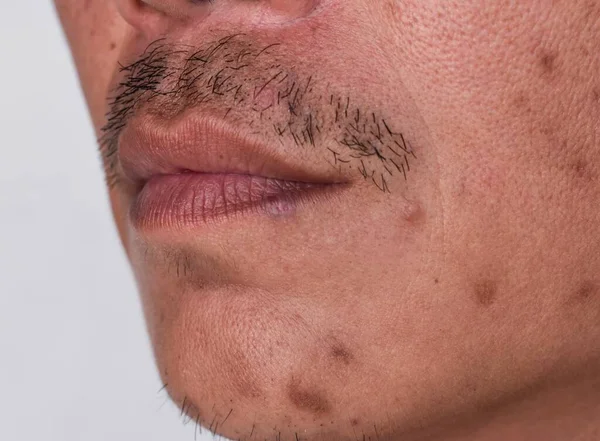 Pequenos Manchas Marrons Chamados Pontos Idade Cicatrizes Rosto Homem Asiático — Fotografia de Stock