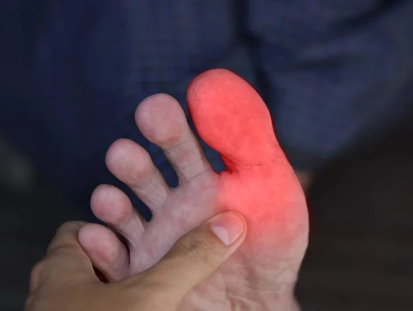 Gyulladás Ázsiai Férfi Nagylábujjában Fogalom Láb Ízületi Fájdalom Arthritis Botlás — Stock Fotó