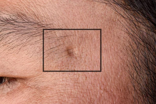 Única Cicatriz Acne Rosto Homem Chinês Asiático — Fotografia de Stock