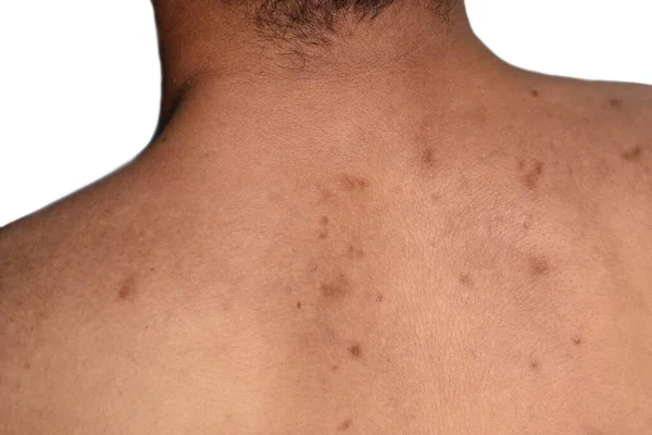 Black Spots Scars Back Asian Myanmar Man — Stock Photo, Image