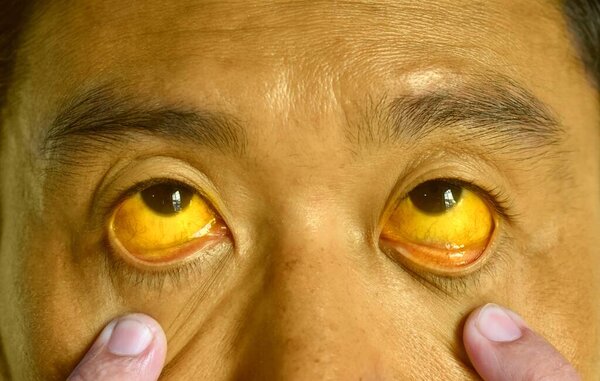 Deep jaundice in Asian male patient. Yellowish discoloration of skin and sclera. Hyperbilirubinemia. Acute hepatitis.