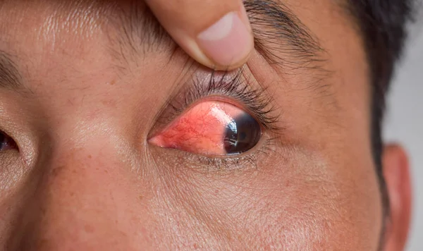 Corneal infection or ulcer called keratitis in Asian Chinese man. Red eye. Sclera inflammation called scleritis. Conjunctivitis. Keratoconjunctivitis.