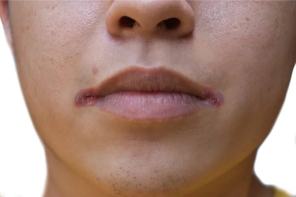 Angular Stomatitis Angular Cheilitis Perleche Asian Young Man Mouth Ulcer — Stock Photo, Image