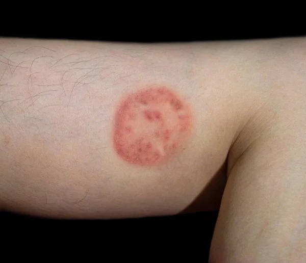 Schimmelinfectie Genaamd Tinea Corporis Zuidoost Aziatische Man Ringworm — Stockfoto
