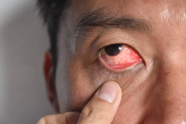 亚裔中国人称为角膜炎的角膜感染或溃疡 — 图库照片