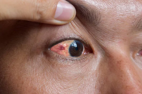 Οφθαλμικές Προνύμφες Μεταναστεύουν Διεσταλμένα Αγγεία Στο Μάτι Του Ανθρώπου Της — Φωτογραφία Αρχείου