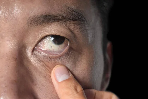 Pale Skin Asian Man Sign Anemia Pallor Eyelid Closeup View — Stock Photo, Image