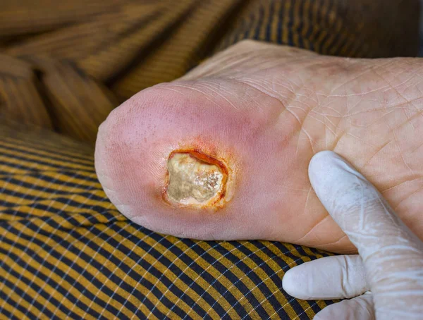 stock image Diabetes foot ulcer in the foot of Asian  male patient.