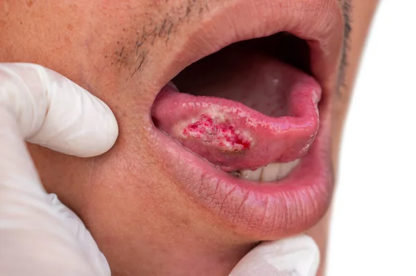 stock image Squamous cell carcinoma of tongue. Oral cancer or malignant tumor of Asian male patient.