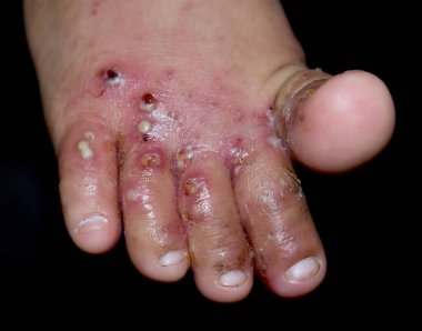 İkincil ya da üst üste yerleştirilmiş bakteri enfeksiyonu ve Asyalı çocuğun ayağında kabarcıklar. Böceklerin neden olduğu bulaşıcı bir deri hastalığı. Siyah üzerine izole edilmiş..