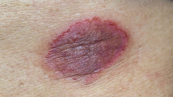 Tinea corporis or ringworm. Itching skin lesions on the abdomen of Asian elderly woman.