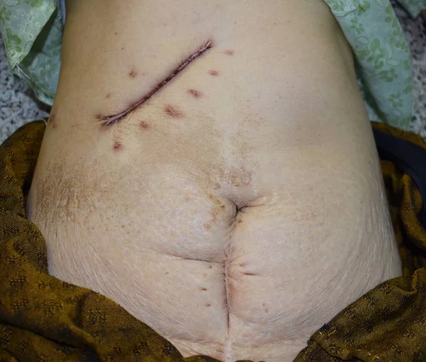 Scar of Kocher incision and lower midline incision at abdomen of the elder woman. 