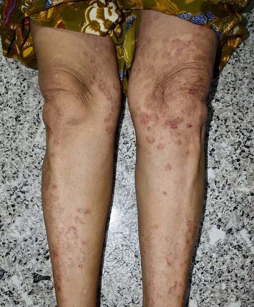 Fungal infection called tinea corporis in leg of Asian woman. Widespread ringworm over lower limb.
