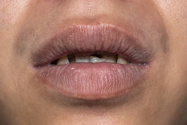 Dry, cracked and dehydrated lips of Asian young man.