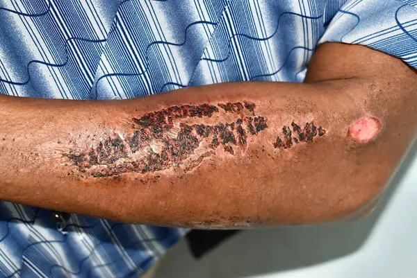 Abschürfungen Und Schorf Oberarm Eines Asiatischen Patienten Trauma Und Verletzung lizenzfreie Stockbilder