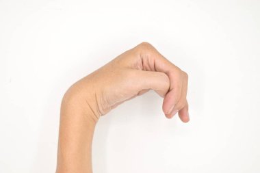 Cerebral palsy hand in Southeast Asian young male patient. Typically seen in hemiplegia and quadriplegia. Wrist joint flexion with ulnar deviation clipart