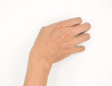 Cerebral palsy hand in Southeast Asian young male patient. Typically seen in hemiplegia and quadriplegia. Wrist joint flexion with ulnar deviation