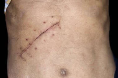 Scar of Kocher incision at abdomen of the elder woman. 